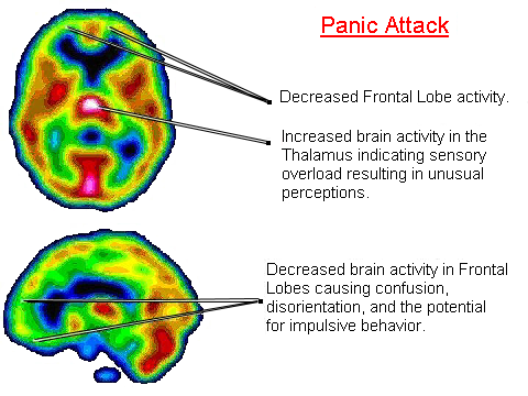 panic-attacks-and-anxiety-linked-to-low-vitamin-b-and-iron-levels